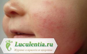 Крапивница у детей