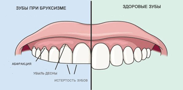Как выглядят зубы при бруксизме