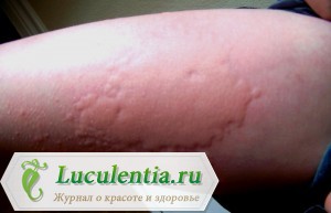 Крапивница